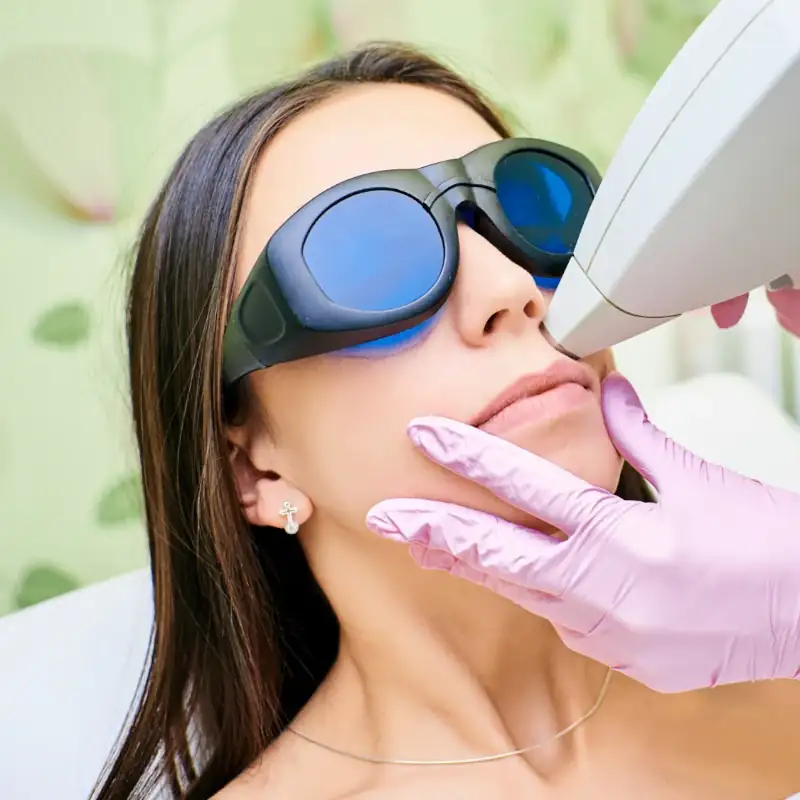 Upper Lip Laser Hair Removal