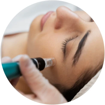 Advanced Microneedling Treatment at Bonita Laser in Mississauga for skin rejuvenation